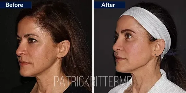 Moxi + BBL HEROIC Before & After