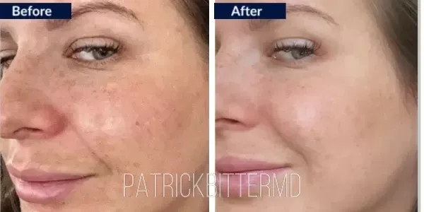 Moxi + BBL HEROIC Before & After