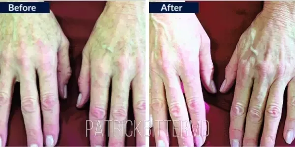 Moxi  Bbl Heroic Before & After