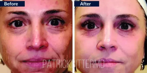 Moxi  Bbl Heroic Before & After