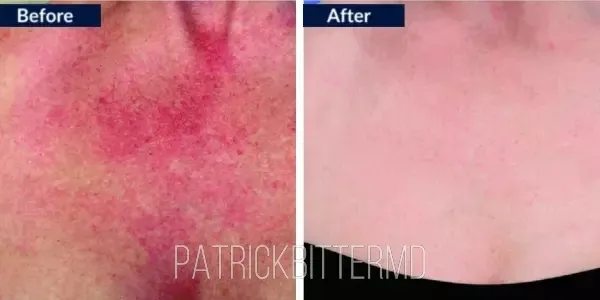 Moxi  Bbl Heroic Before & After