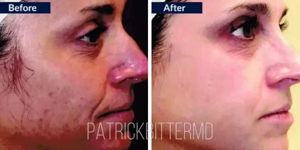 Moxi + BBL HEROIC Before & After