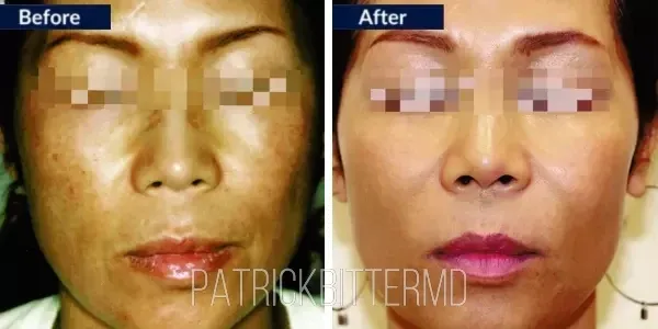 Moxi  Bbl Heroic Before & After