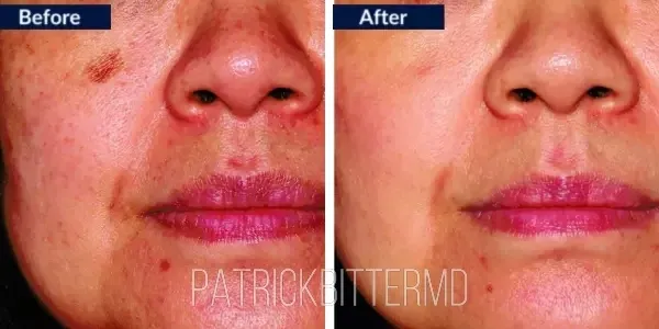 Moxi  Bbl Heroic Before & After