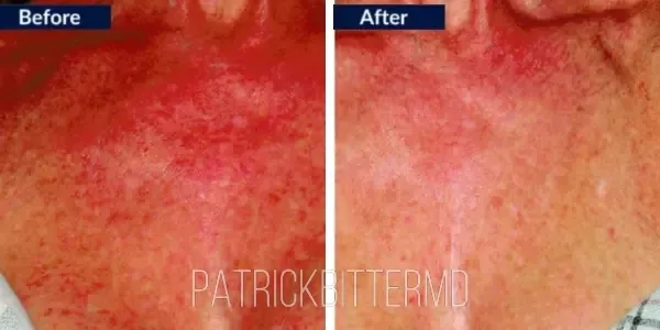 Moxi  Bbl Heroic Before & After