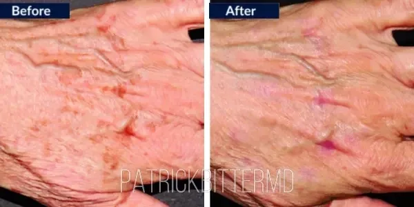 Moxi  Bbl Heroic Before & After