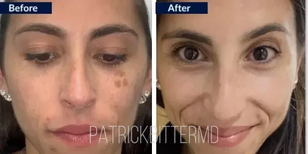 Moxi  Bbl Heroic Before & After