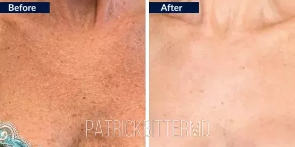 Moxi  Bbl Heroic Before & After