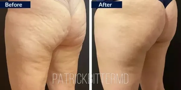 Moxi  Bbl Heroic Before & After