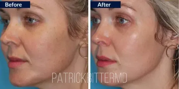 Moxi  Bbl Heroic Before & After