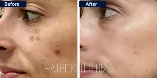 Moxi + BBL HEROIC Before & After