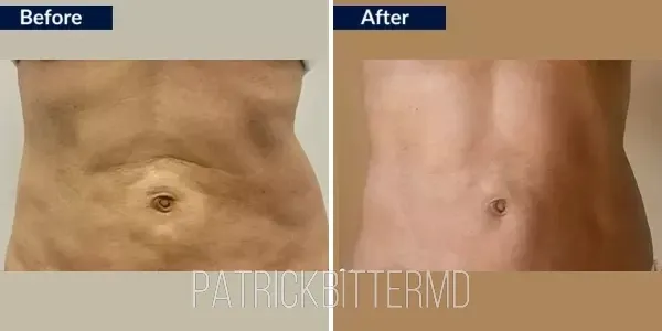 Moxi  Bbl Heroic Before & After