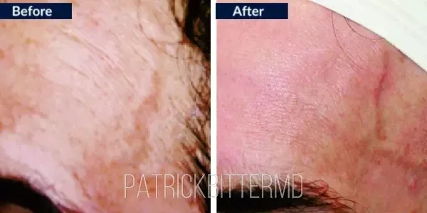 Moxi  Bbl Heroic Before & After