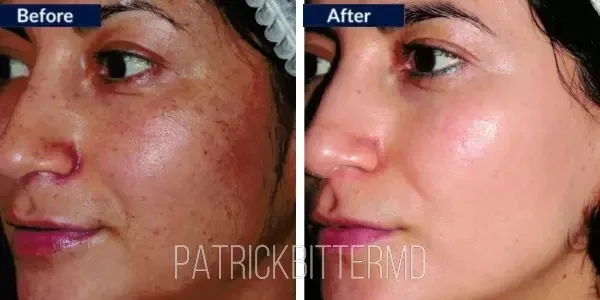 Moxi  Bbl Heroic Before & After