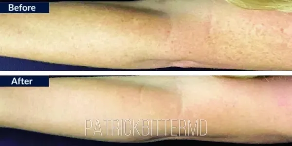 Moxi  Bbl Heroic Before & After