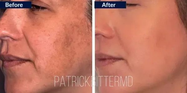 Moxi  Bbl Heroic Before & After