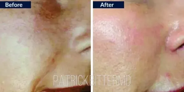 Moxi  Bbl Heroic Before & After