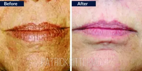 Moxi  Bbl Heroic Before & After