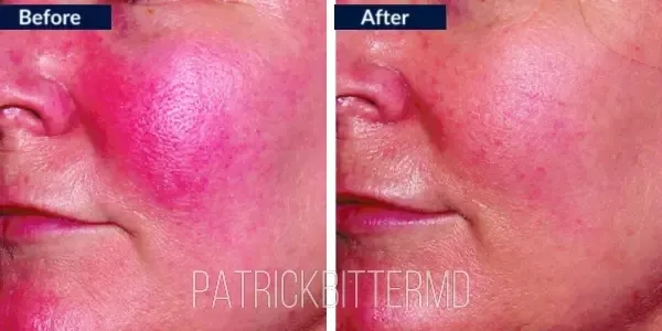 Moxi  Bbl Heroic Before & After