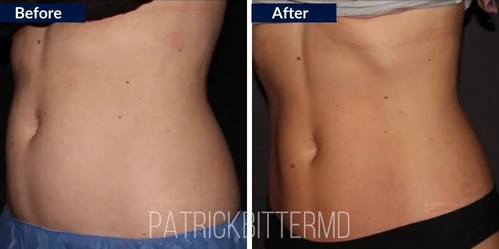 Cooltone Coolsculpting Before & After
