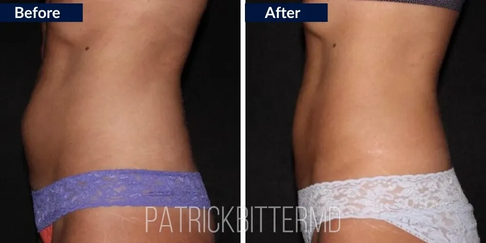 Cooltone Coolsculpting Before & After