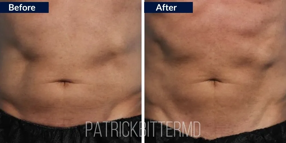 Cooltone Coolsculpting Before & After