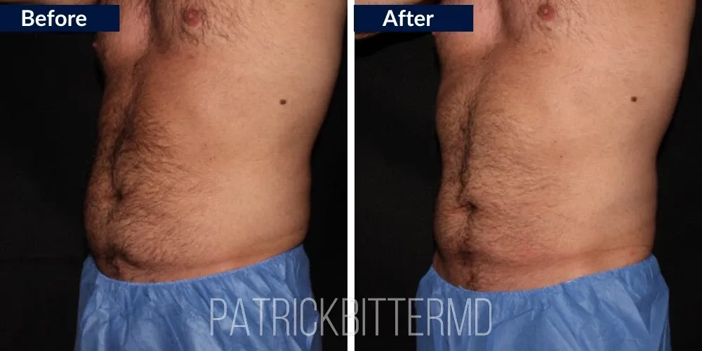 Cooltone Coolsculpting Before & After