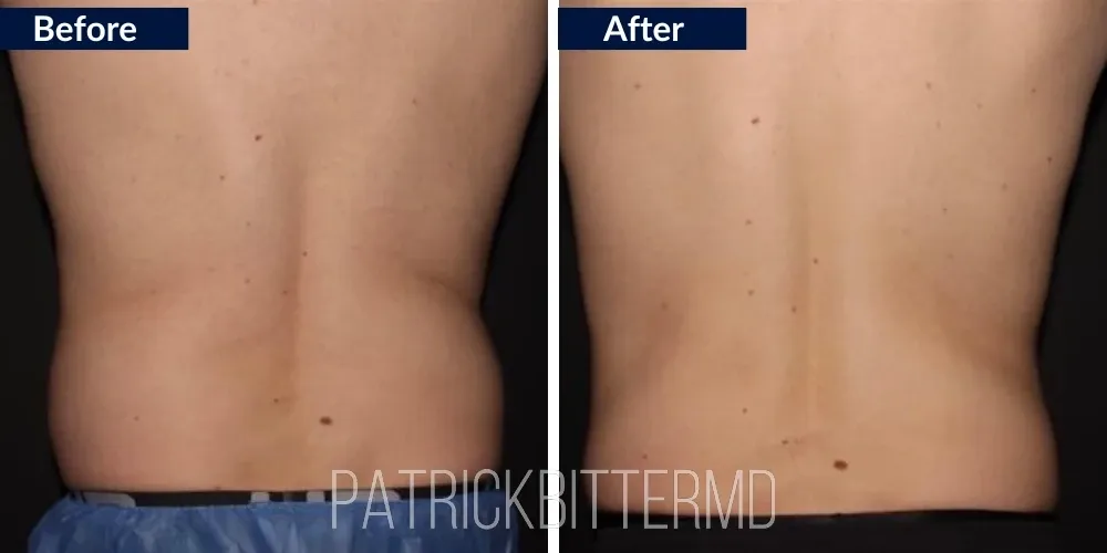 Cooltone Coolsculpting Before & After