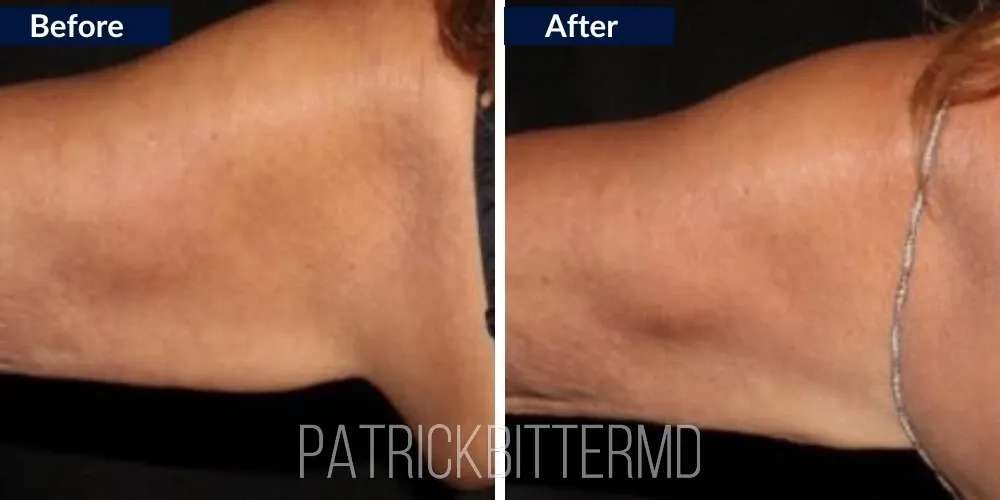 Cooltone Coolsculpting Before & After