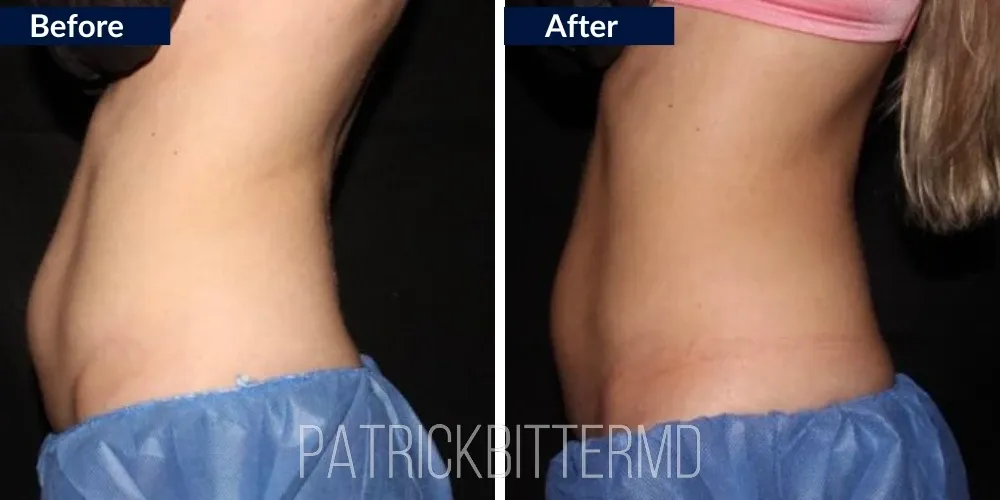 Cooltone Coolsculpting Before & After