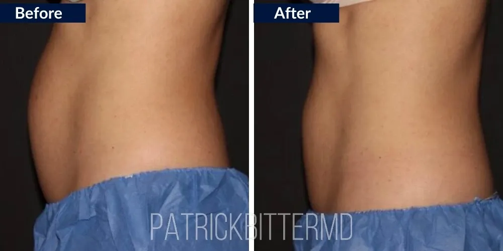 Cooltone Coolsculpting Before & After