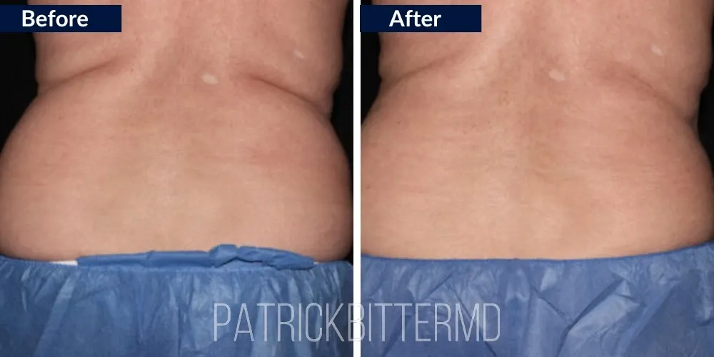 Cooltone Coolsculpting Before & After