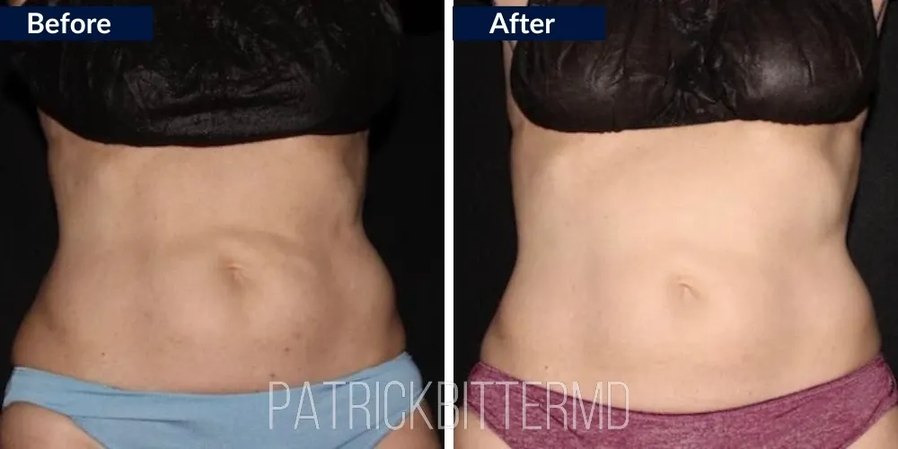 Cooltone Coolsculpting Before & After