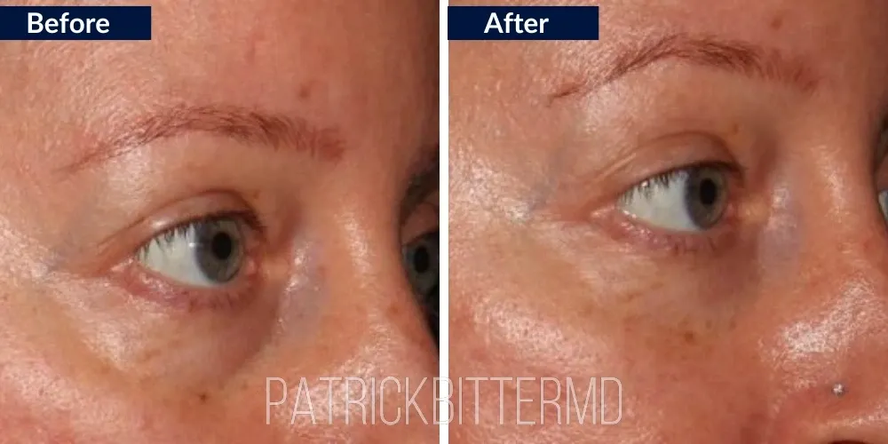 Fillers  Injectables Before & After