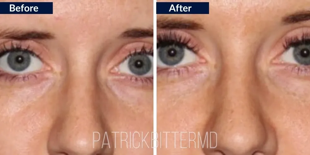 Fillers  Injectables Before & After