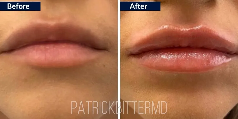 Fillers  Injectables Before & After