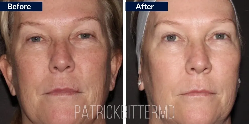 Fotofacial Flawless Facial Before & After