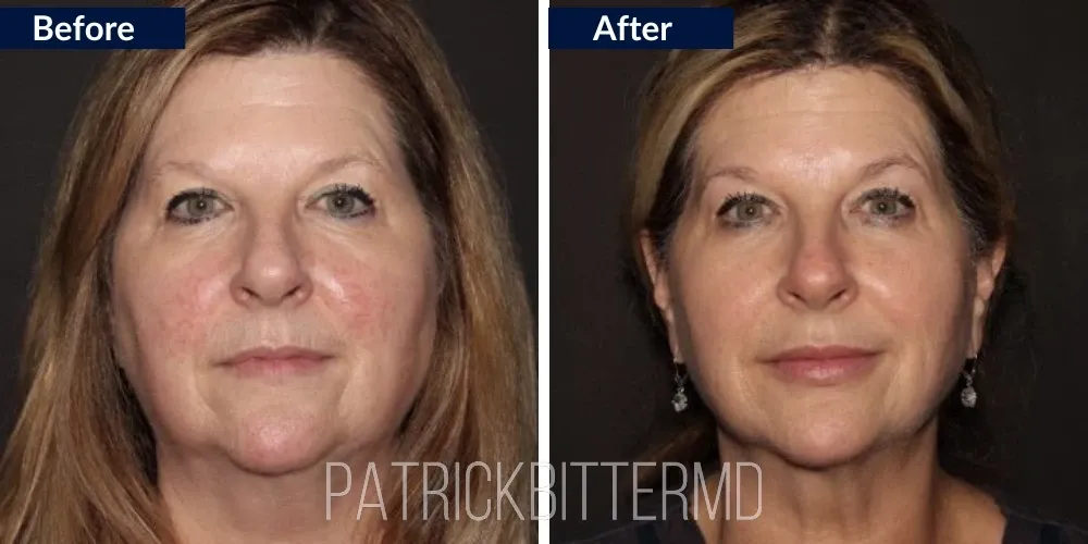 Fotofacial Flawless Facial Before & After
