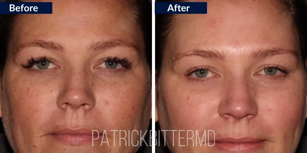 Fotofacial Flawless Facial Before & After
