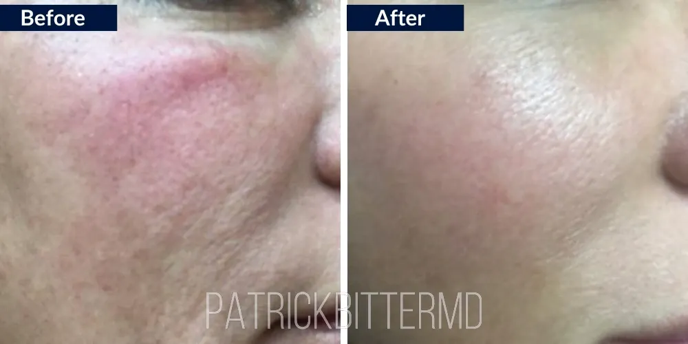 Fotofacial Flawless Facial Before & After