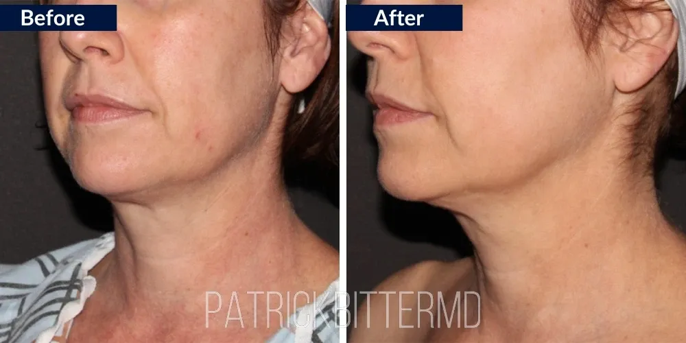 Fotofacial Flawless Facial Before & After