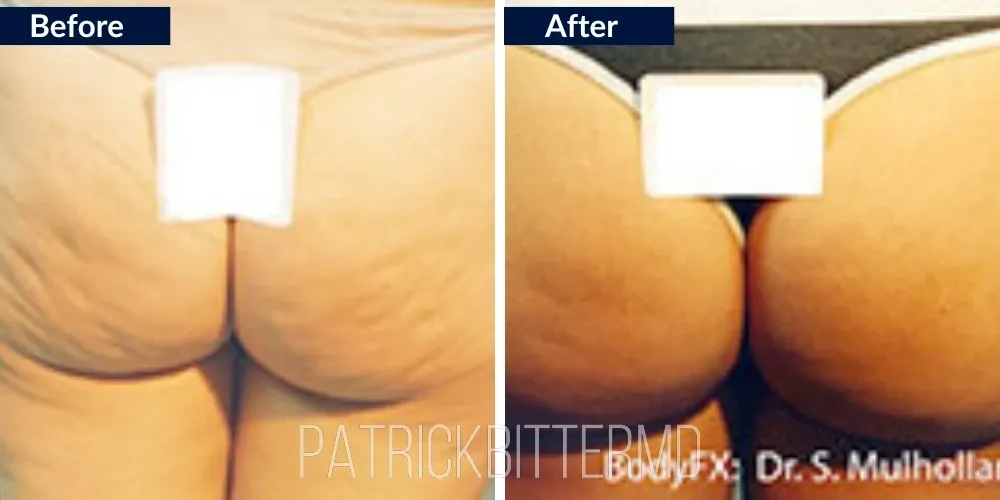Bodyfx Before & After