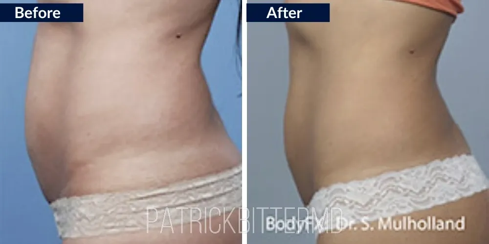 Bodyfx Before & After