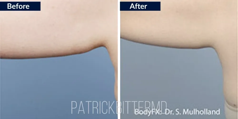 Bodyfx Before & After