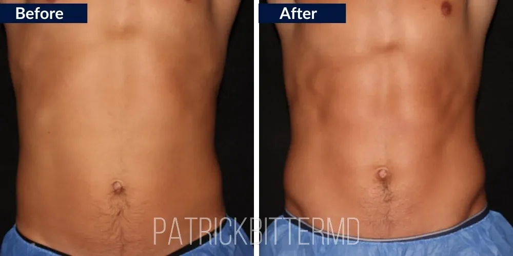 Procedure Before & After