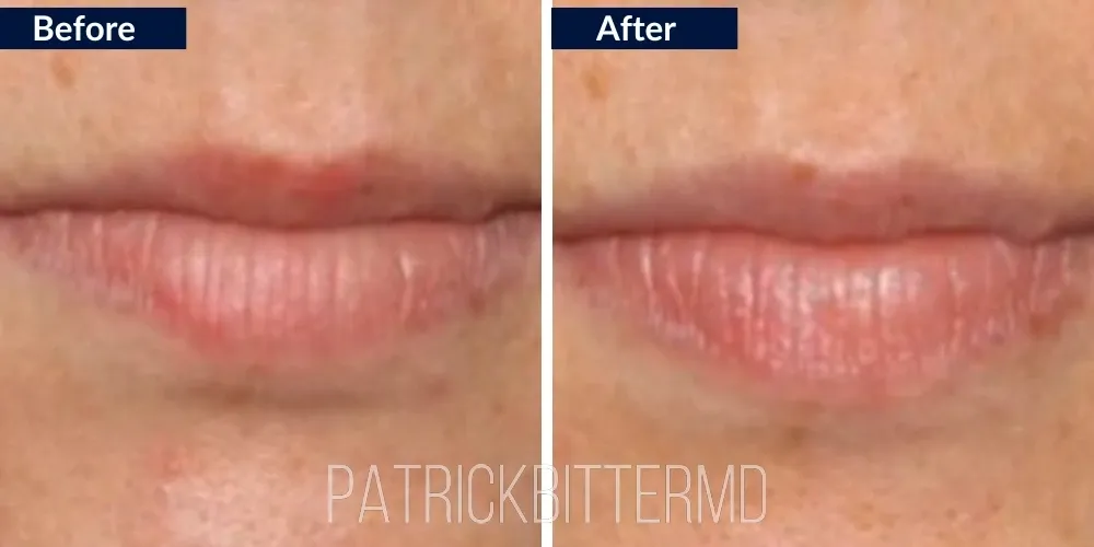 Lips Before & After