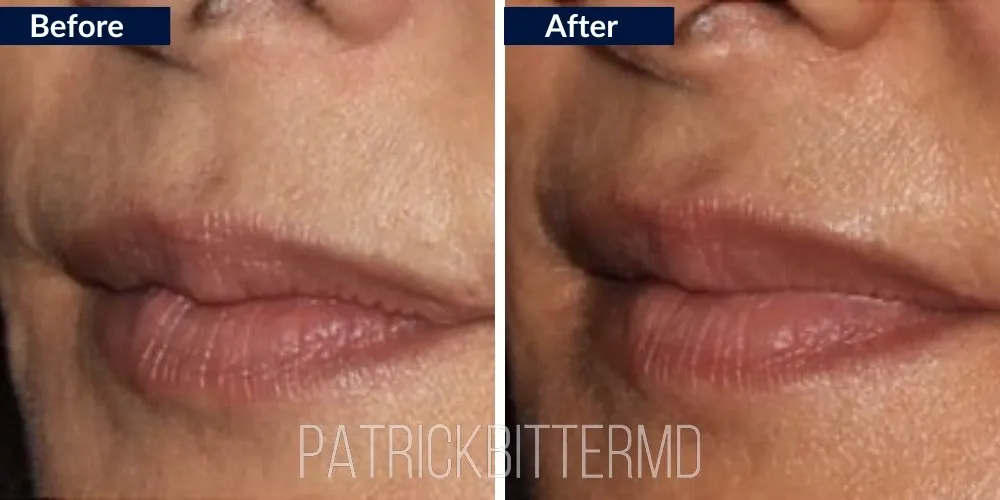 Lips Before & After