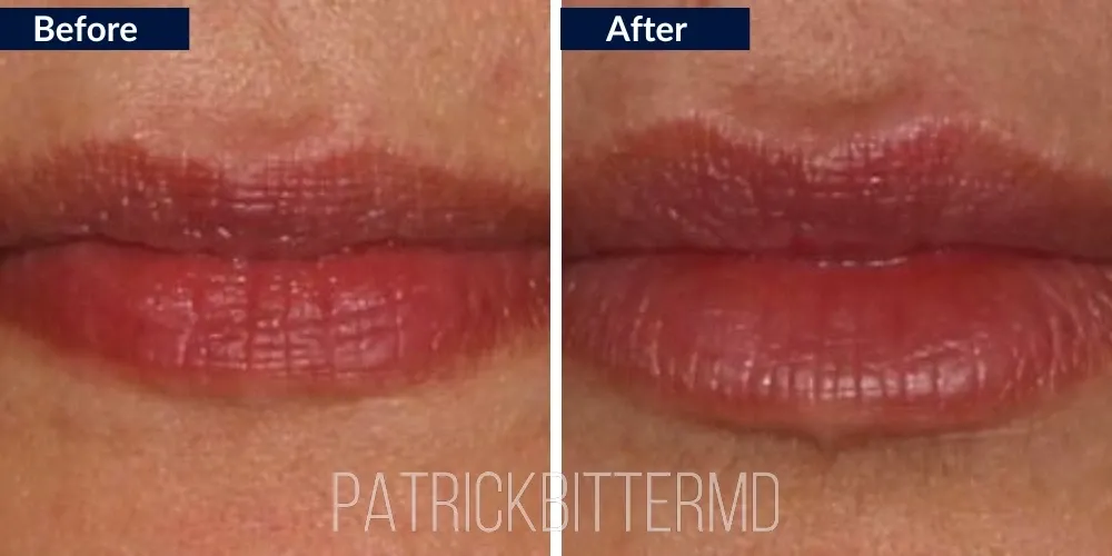 Lips Before & After