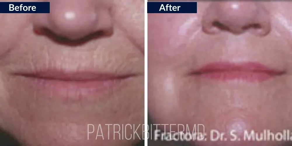 Fractora Rf Microneedling Before & After