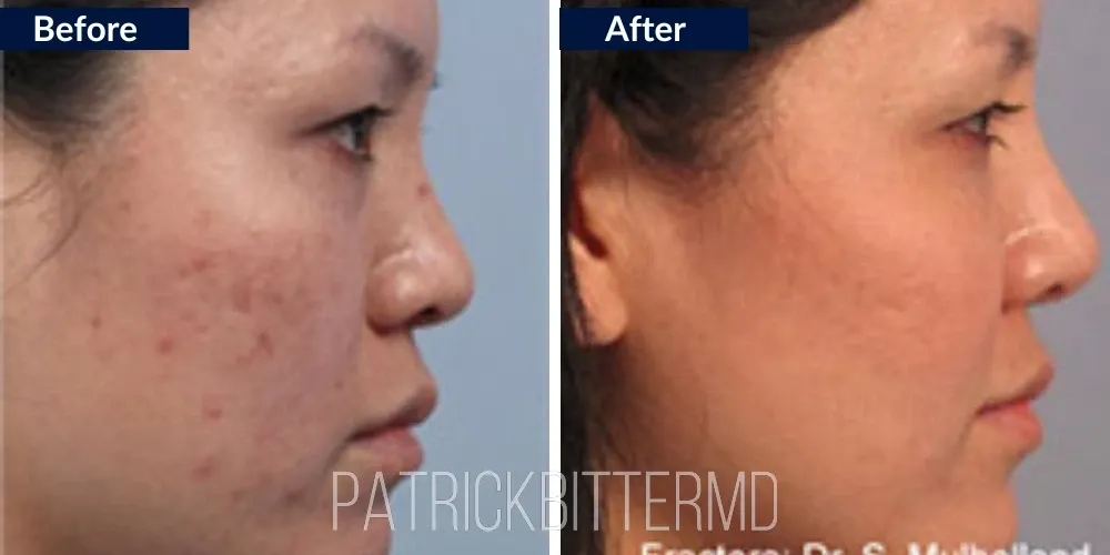 Fractora Rf Microneedling Before & After
